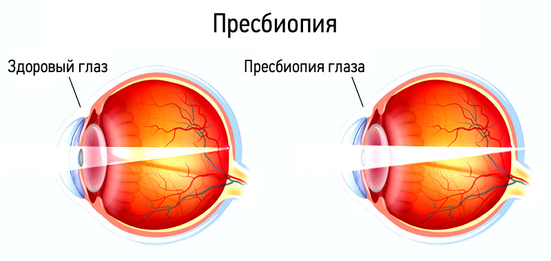 1545161000_presbiopiya.jpg 1545161000_presbiopiya.jpg